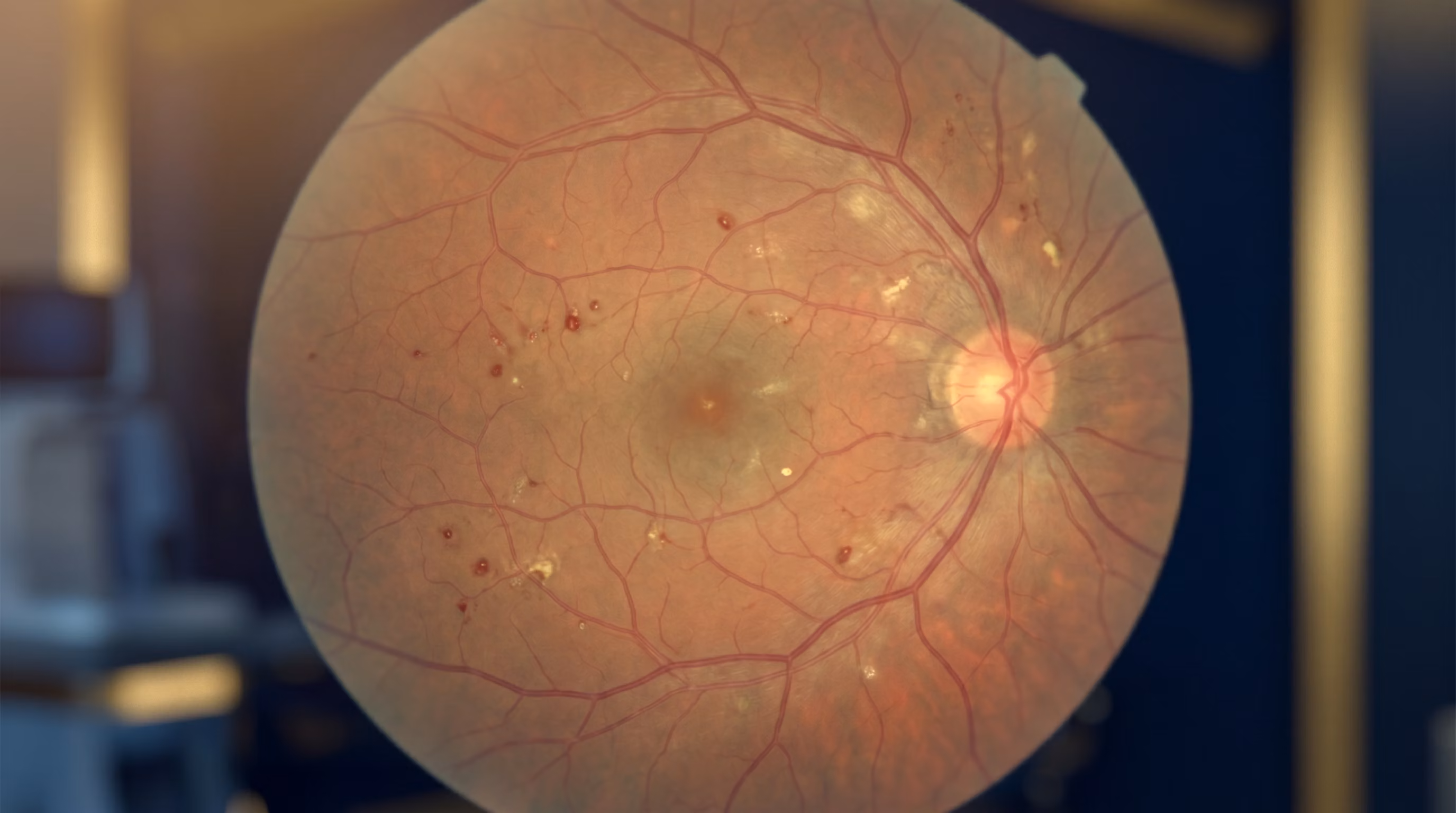 Imagem de capa do artigo Retinopatia Diabética: Como o Diabetes Afeta a Visão, conteúdo da categoria Retina.
