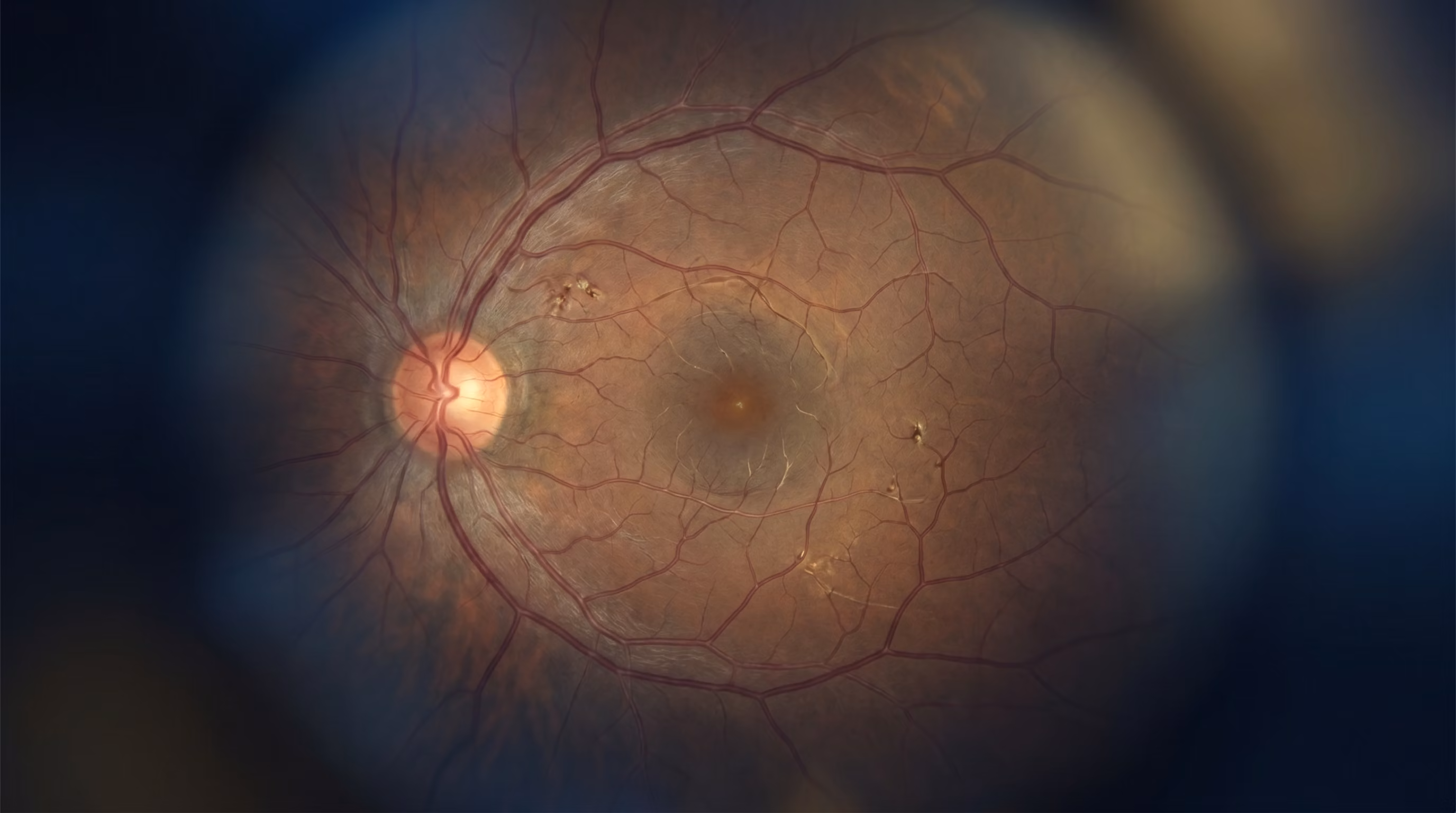 Retinopatia Diabética: Diagnóstico Precoce, Tratamento com Anti-VEGF e Laser — Guia Completo 2025