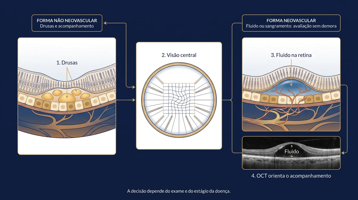 Prancha clínica sobre DMRI mostrando drusas, alteração da visão central, fluido na retina e o papel do OCT no acompanhamento