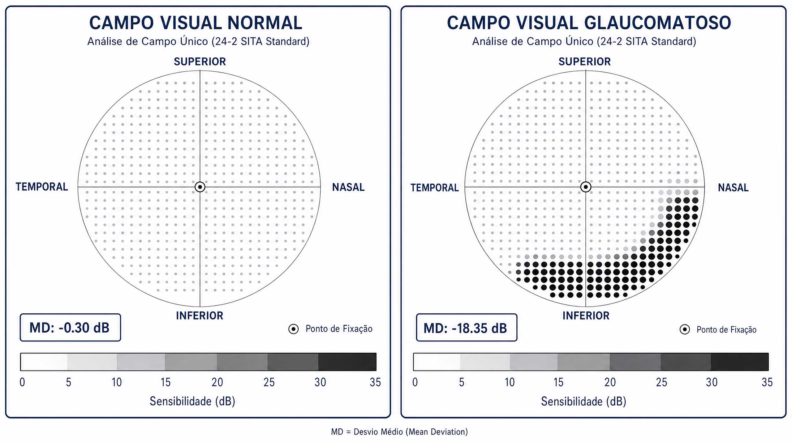 Comparação entre campo visual normal e campo visual glaucomatoso — exame de Humphrey mostrando escotoma arciforme inferior e perda de campo visual periférico no glaucoma
