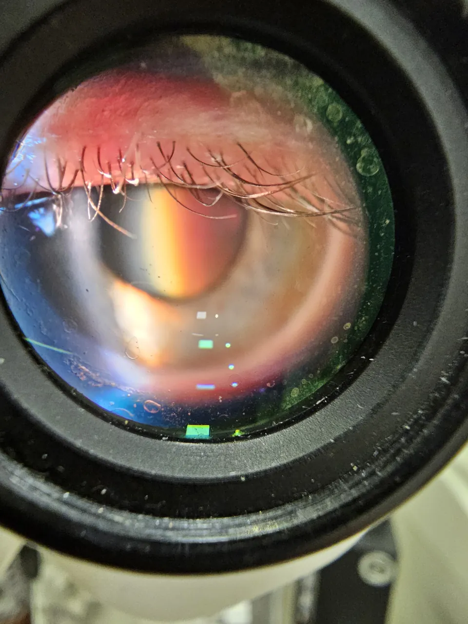 O olho de um paciente visto pela ocular da lâmpada de fenda, durante o exame