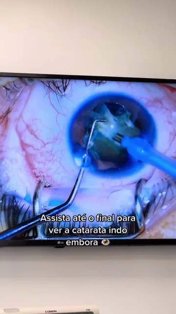 Capa do vídeo "Que alívio, hein?": a cirurgia de catarata vista pelo microscópio, numa tela de televisão