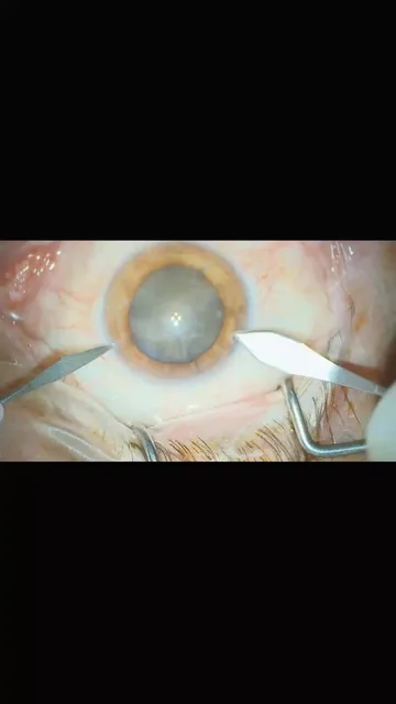 Capa do vídeo: o olho durante a cirurgia de catarata, com a lente opaca entre dois instrumentos, vista pelo microscópio